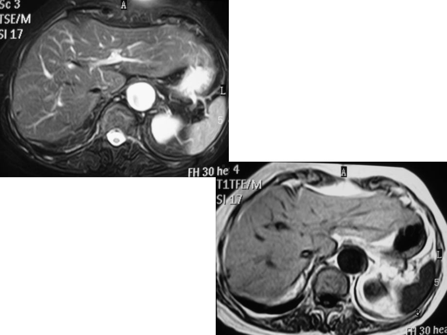 肝脏常见病变的高级诊断课件.ppt_第3页