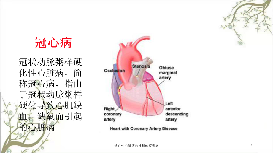 缺血性心脏病的外科治疗进展课件.ppt_第2页