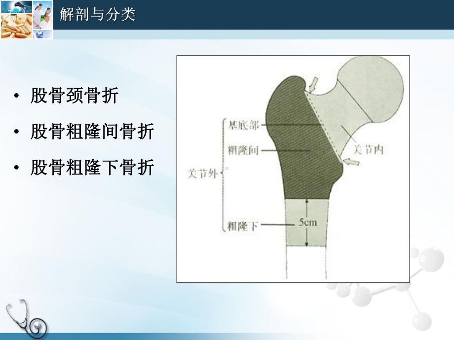 粗隆间骨折教材课件.ppt_第2页