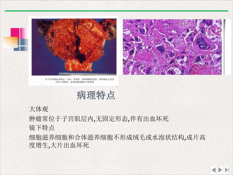 绒癌护理查房课件.pptx_第2页