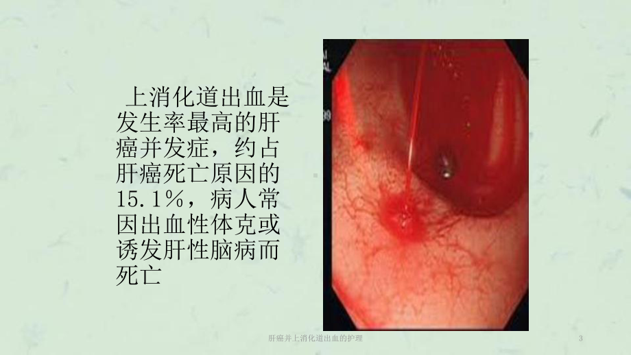 肝癌并上消化道出血的护理课件.ppt_第3页