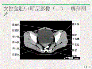 盆腔CT诊断版课件.pptx