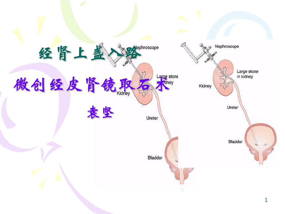 经肾上盏入路微创经皮肾镜取术医学课件.ppt_第1页