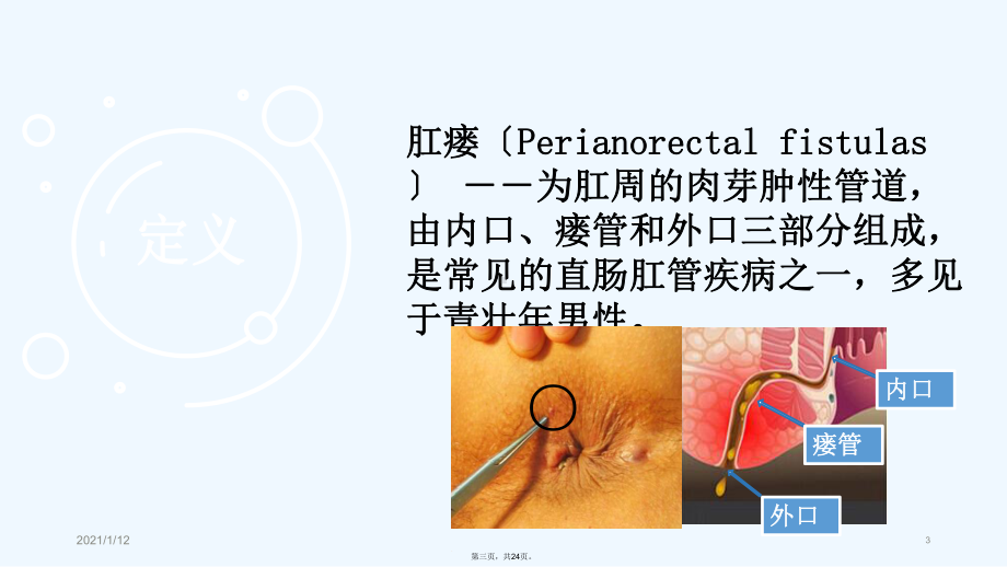 肛瘘患者护理查房课件.ppt_第3页