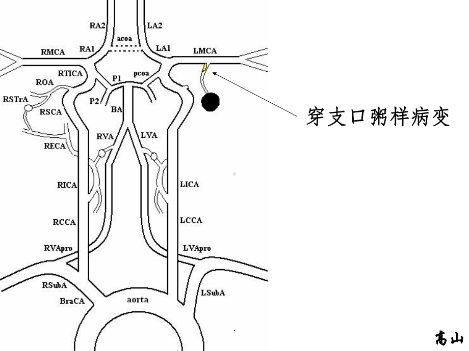 穿支动脉梗死的病因和机制课件.ppt_第3页