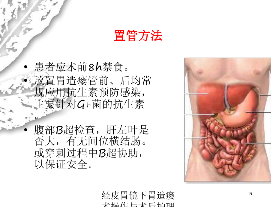 经皮胃镜下胃造瘘术操作与术后护理培训课件.ppt_第3页