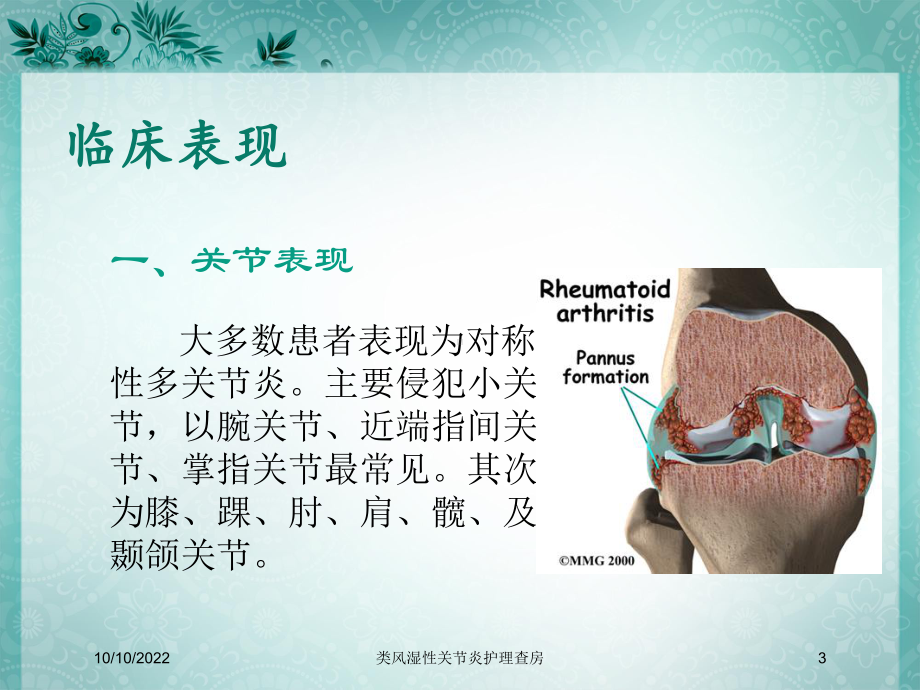 类风湿性关节炎护理查房培训课件.ppt_第3页