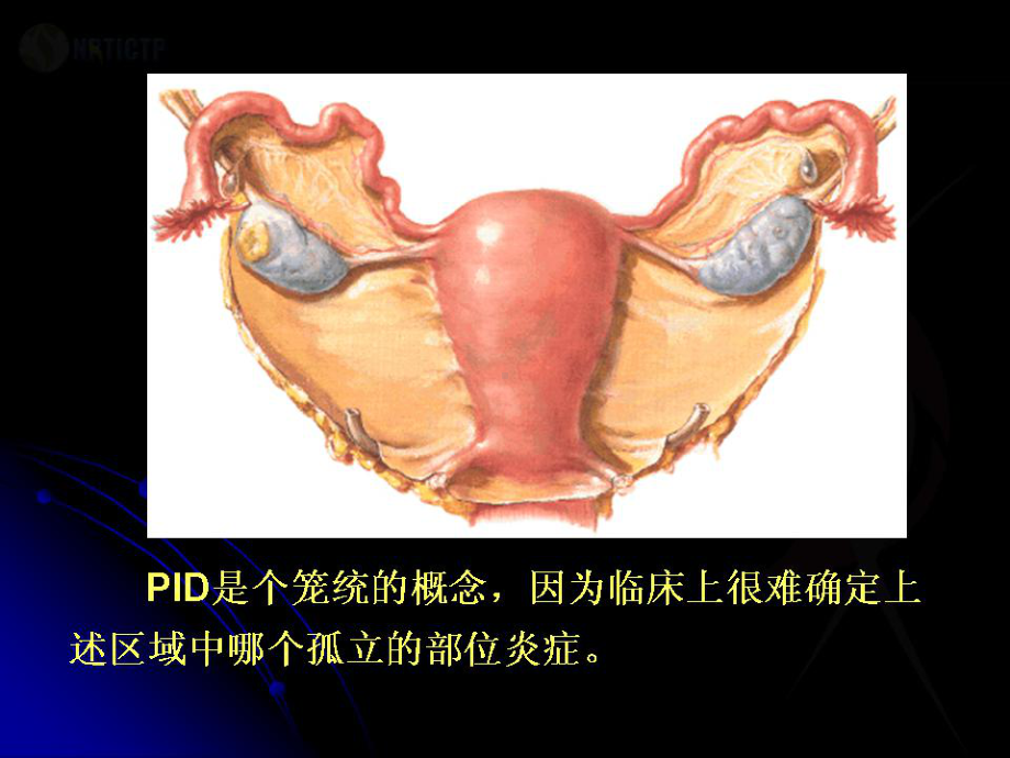 盆腔炎性疾病诊治新规范培训课件-2.ppt_第3页