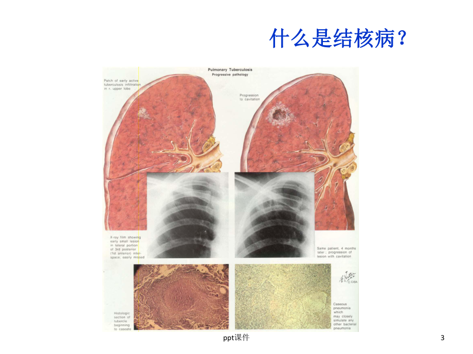 结核病防治知识讲座-课件.ppt_第3页