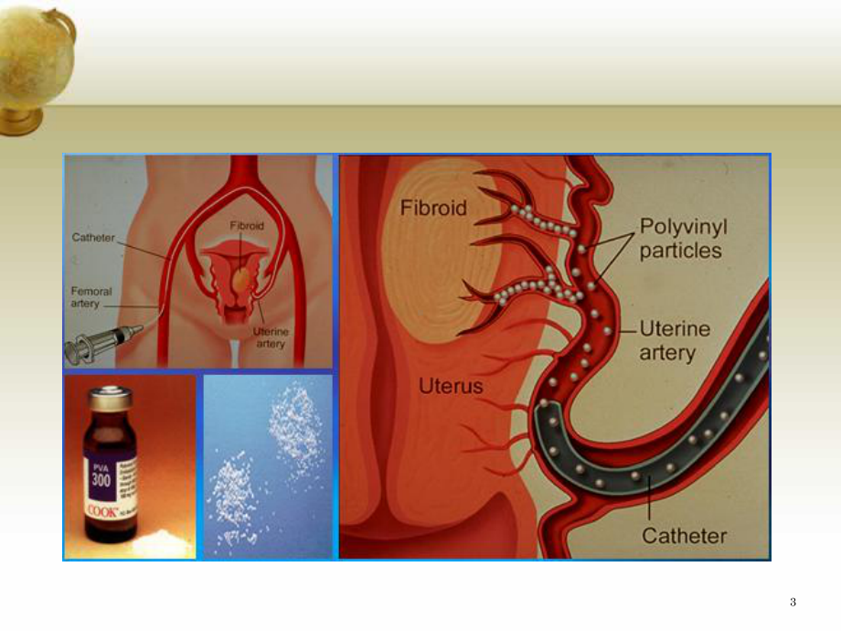 经皮子宫动脉栓塞术治疗产后出血课件.ppt_第3页