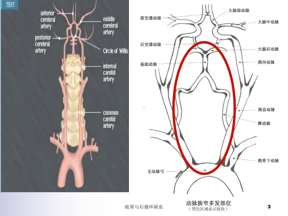 眩晕与后循环缺血课件.ppt_第3页