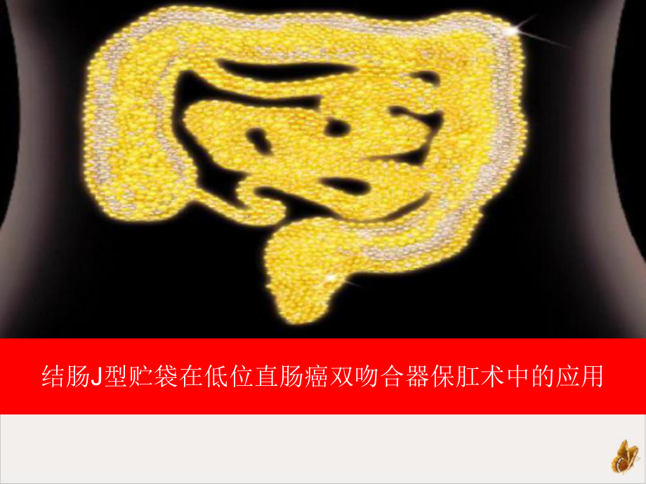 结肠J型贮袋在低位直肠癌双吻合器保肛术中的应用精选课件.ppt_第1页