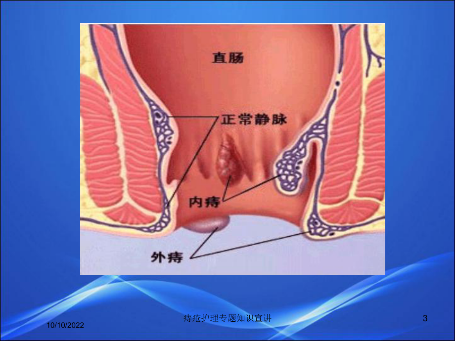 痔疮护理专题知识宣讲培训课件.ppt_第3页