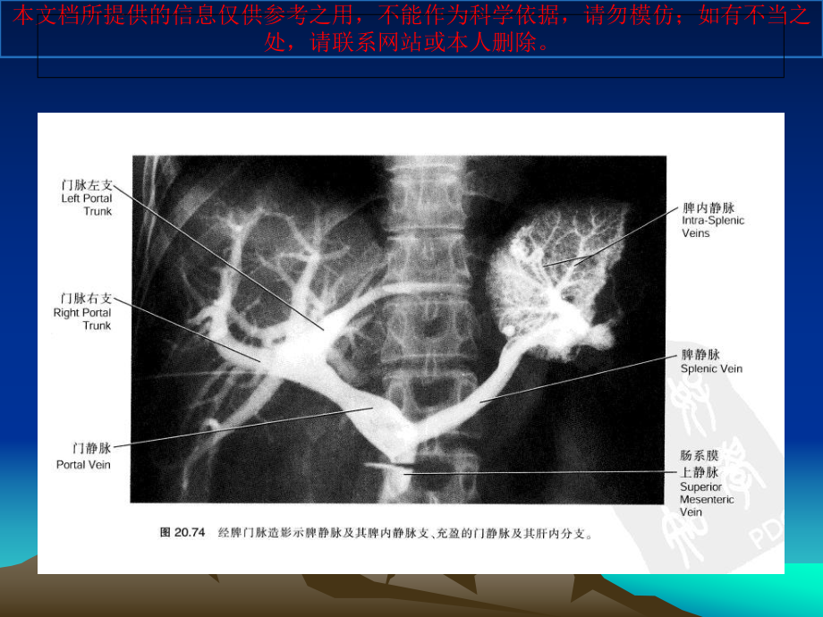 肝硬化食管胃底静脉曲张大出血介入治疗培训课件.ppt_第3页