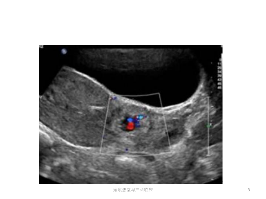 瘢痕憩室与产科临床课件.pptx_第3页