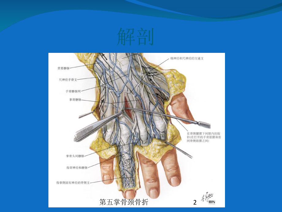 第五掌骨颈骨折培训课件.ppt_第2页