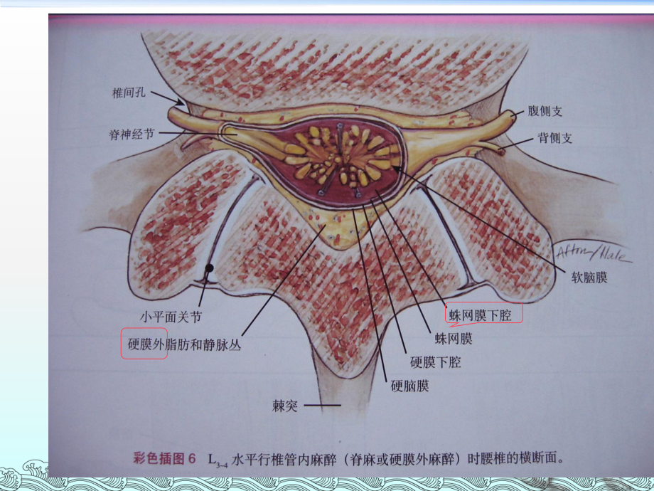 第十一章-椎管内麻醉及护理-课件.ppt_第3页