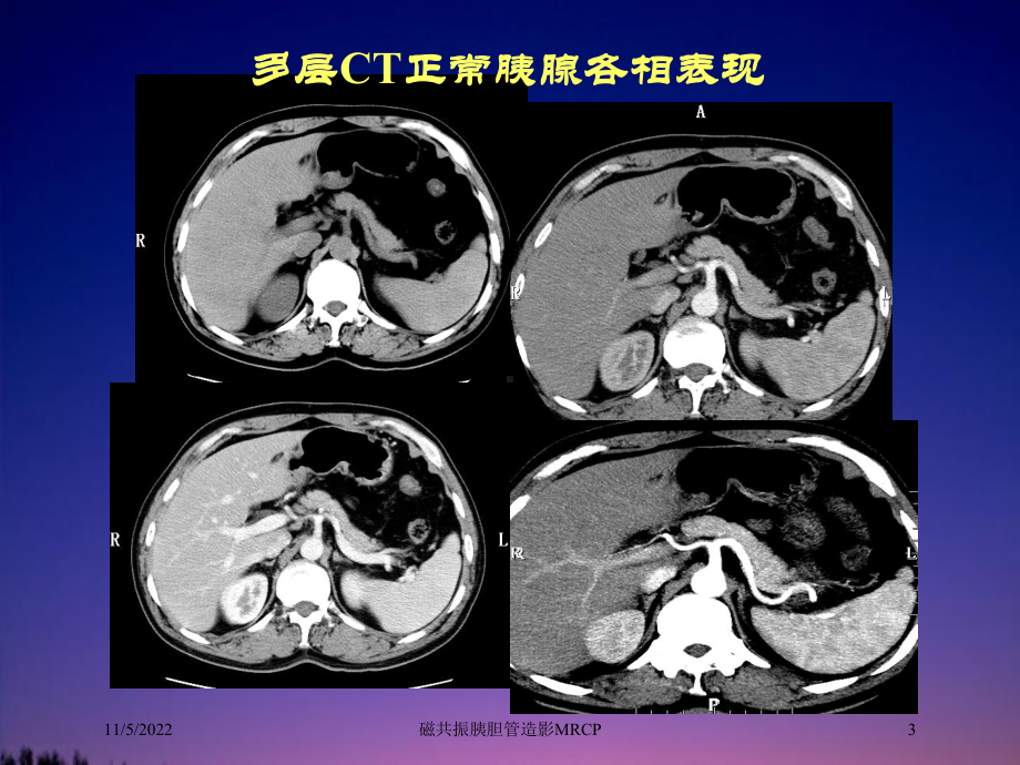 磁共振胰胆管造影MRCP培训课件.ppt_第3页