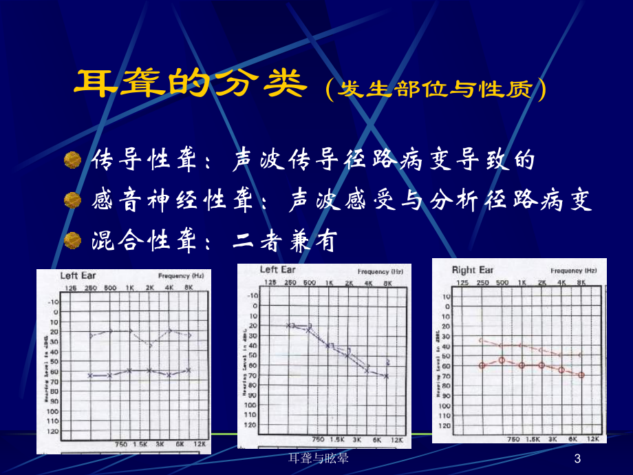 耳聋与眩晕课件.ppt_第3页