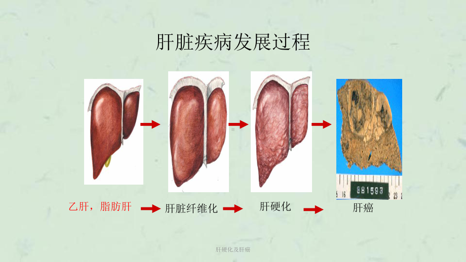 肝硬化及肝癌课件.pptx_第3页