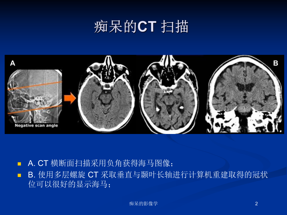 痴呆的影像学培训课件.ppt_第2页