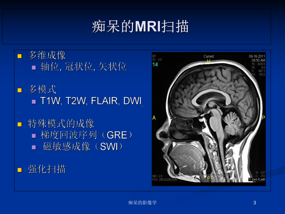 痴呆的影像学培训课件.ppt_第3页