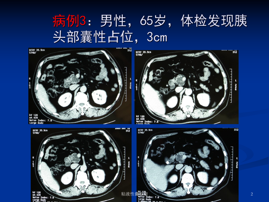 粘液性囊腺瘤培训课件.ppt_第2页