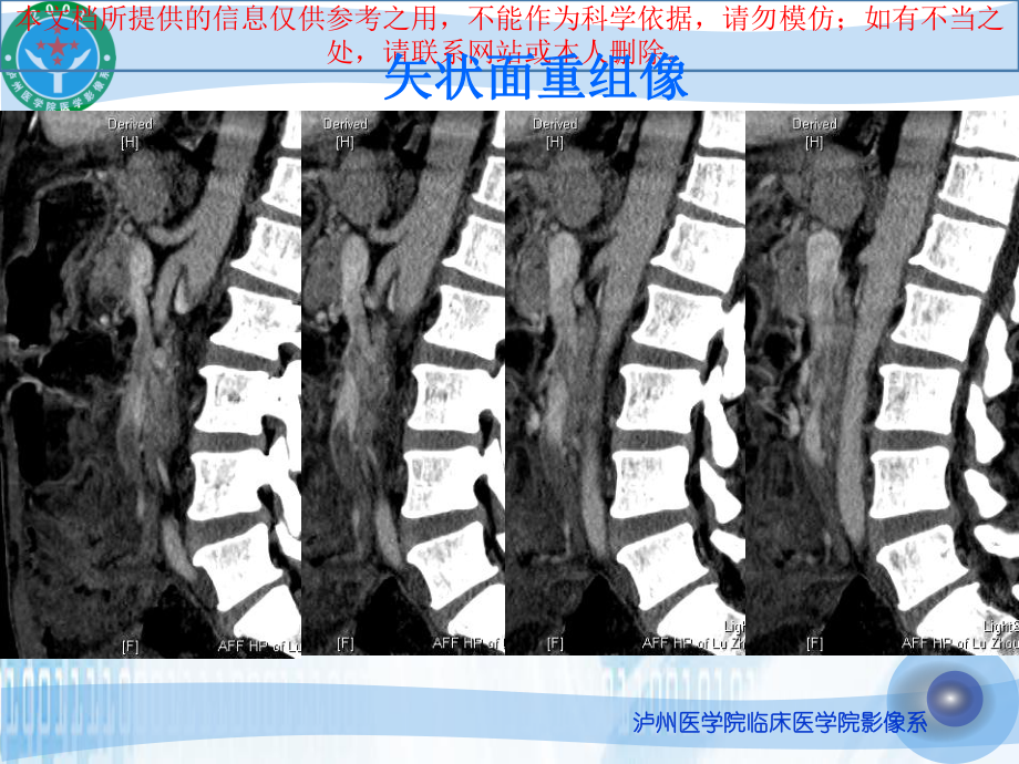 缺血性肠病的影像诊疗培训课件.ppt_第1页