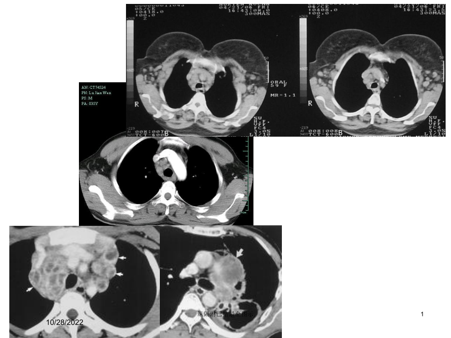 纵隔淋巴结最全图示培训课件.ppt_第1页