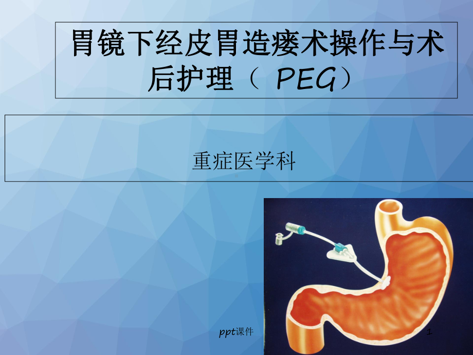 经皮胃镜下胃造瘘术操作与术后护理-课件.ppt_第1页