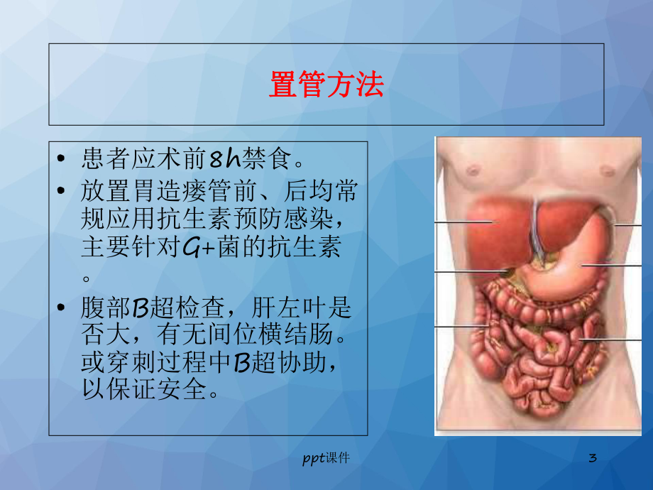 经皮胃镜下胃造瘘术操作与术后护理-课件.ppt_第3页