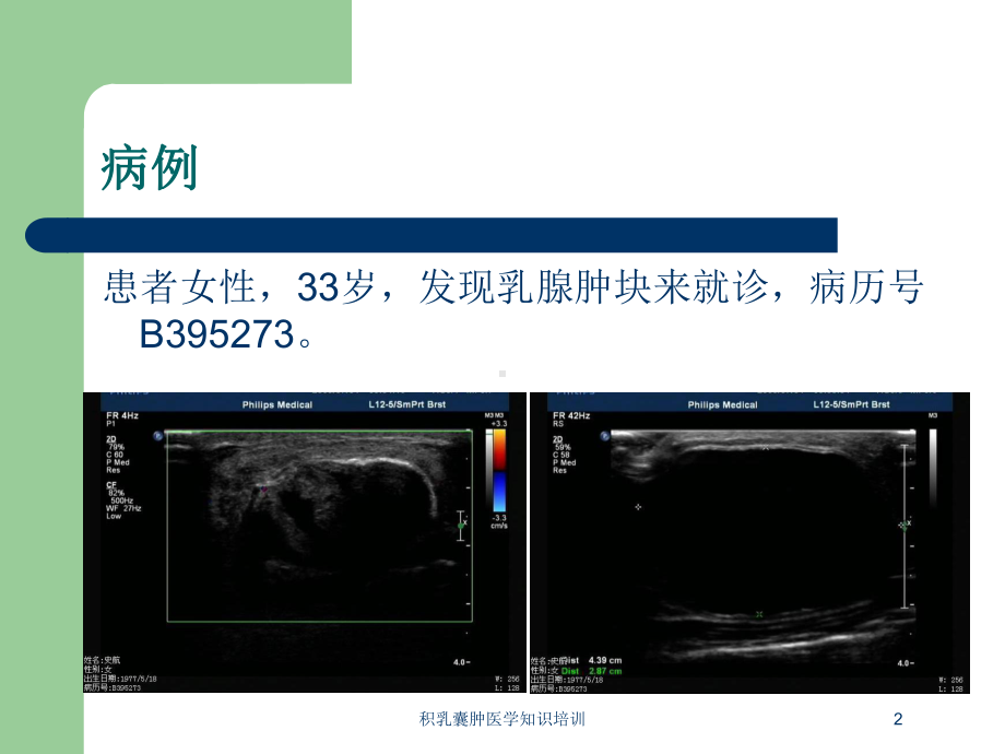 积乳囊肿医学知识培训培训课件.ppt_第2页