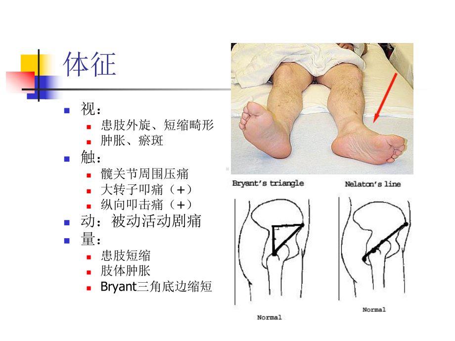 老年髋部骨折股骨颈骨折股骨转子间骨折课件.ppt_第3页