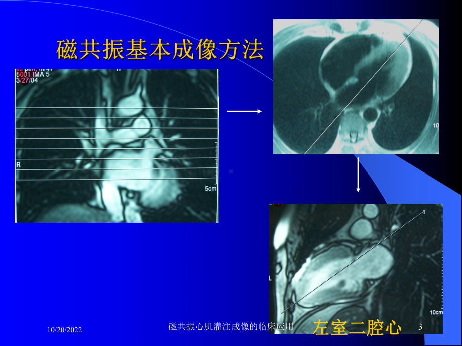 磁共振心肌灌注成像的临床应用培训课件.ppt_第3页