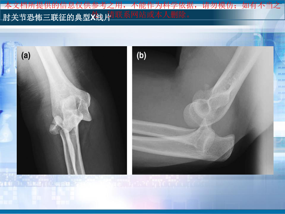 肘关节恐怖三联征培训课件.ppt_第2页