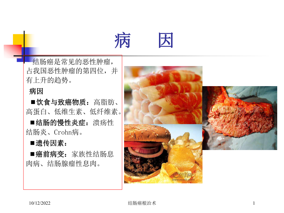 结肠癌根治术培训课件.ppt_第1页