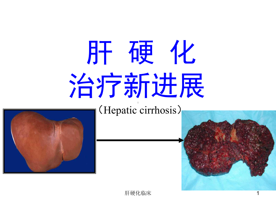 肝硬化临床课件.ppt_第1页