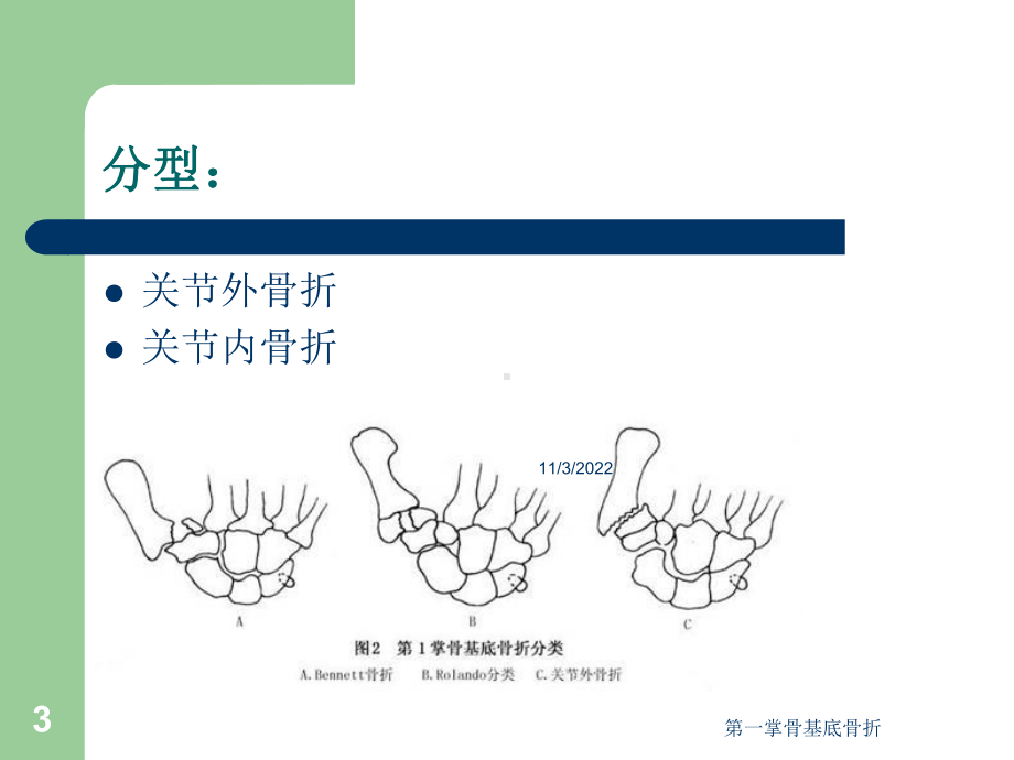 第一掌骨基底骨折培训课件.ppt_第3页