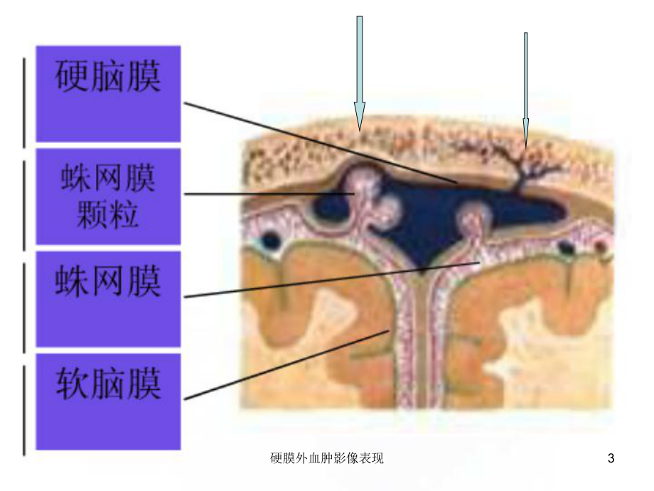 硬膜外血肿影像表现课件.ppt_第3页