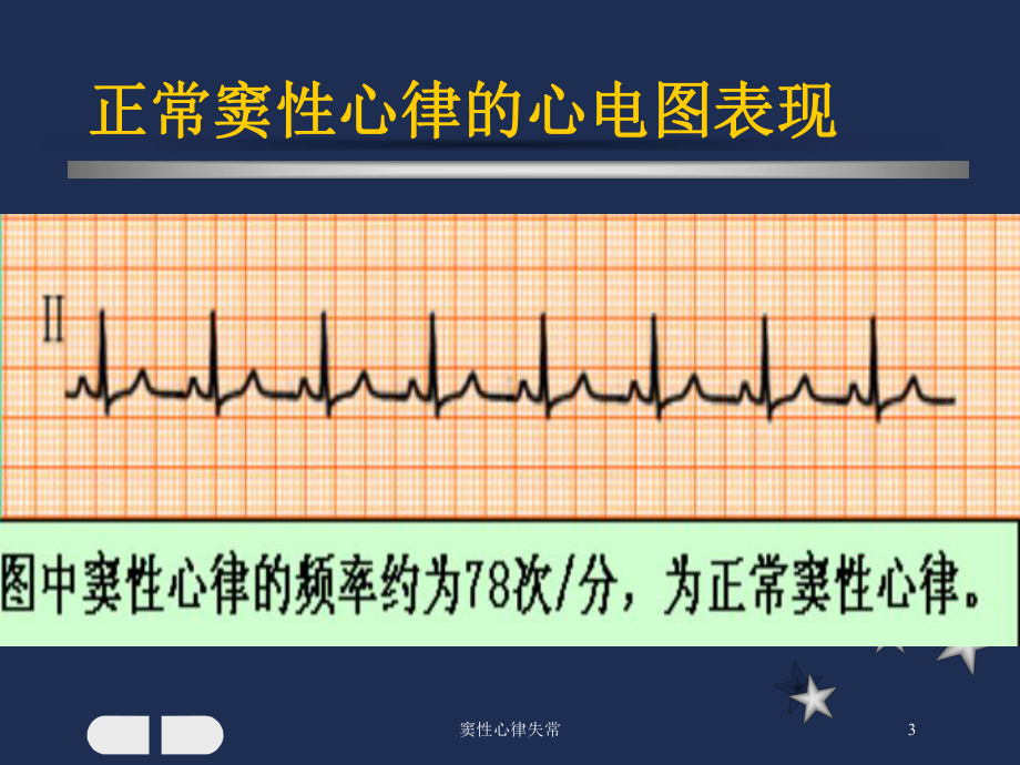 窦性心律失常培训课件.ppt_第3页