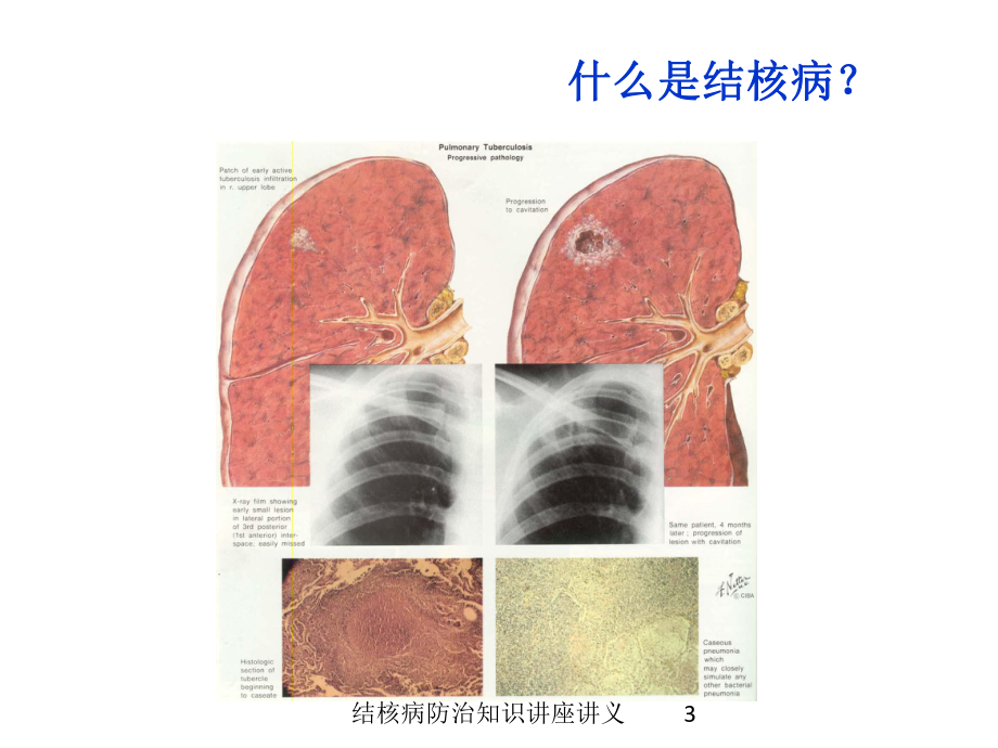 结核病防治知识讲座讲义培训课件.ppt_第3页