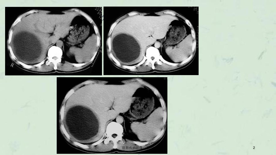 肝脏疾病影像诊断课件.ppt_第2页