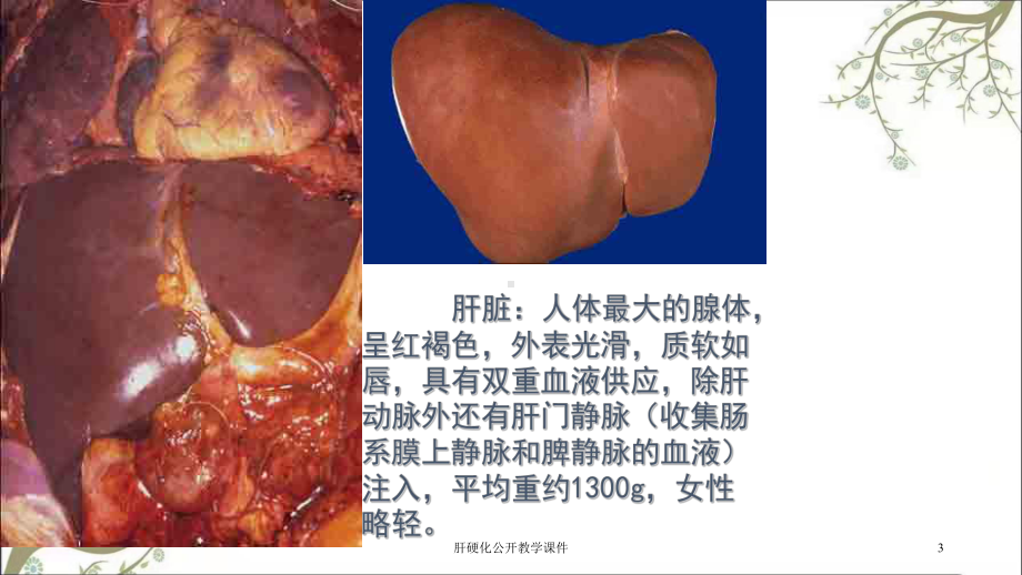 肝硬化公开教学课件.ppt_第3页