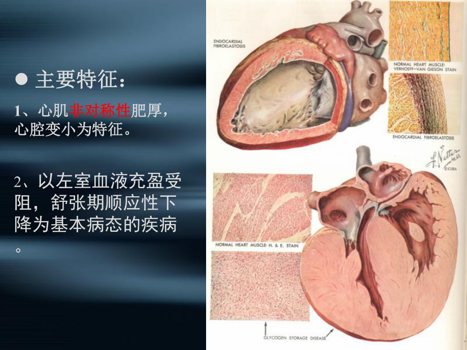 八章心肌病(二)课件.ppt_第2页