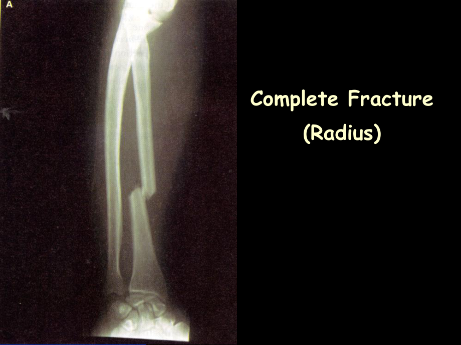 Bone-Fractures--SchoolWorld-an-Edline-Solution：骨折schoolworld一艾里尼溶液课件.ppt_第1页