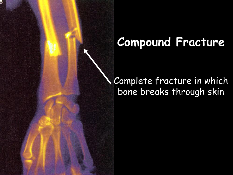 Bone-Fractures--SchoolWorld-an-Edline-Solution：骨折schoolworld一艾里尼溶液课件.ppt_第2页