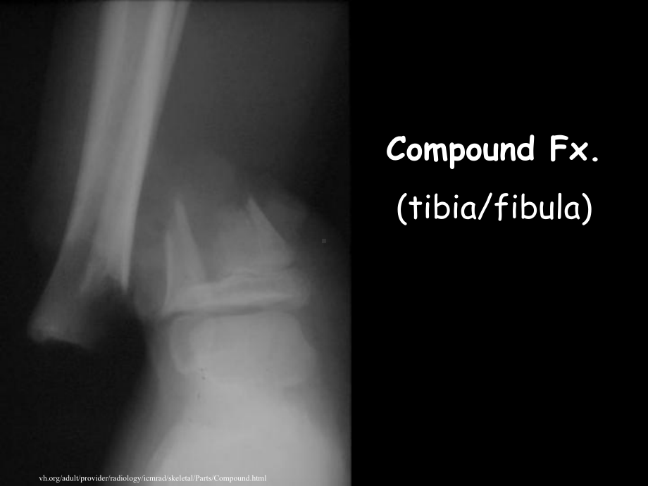 Bone-Fractures--SchoolWorld-an-Edline-Solution：骨折schoolworld一艾里尼溶液课件.ppt_第3页