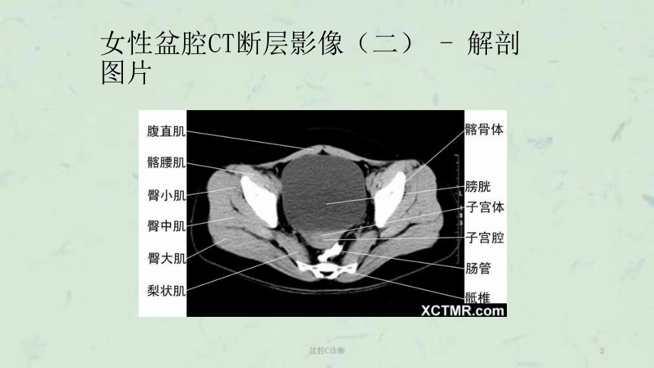 盆腔C诊断课件.ppt_第2页