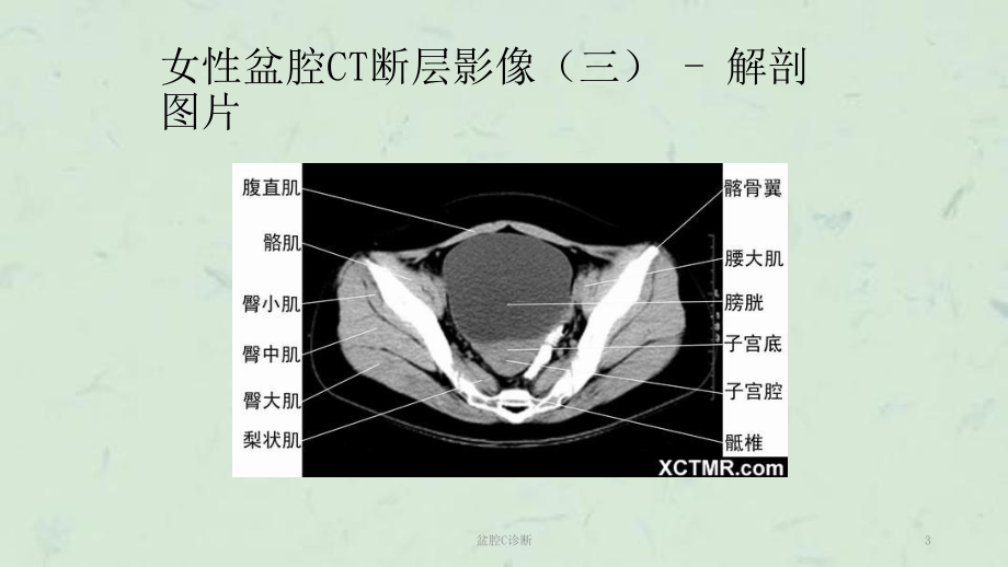 盆腔C诊断课件.ppt_第3页