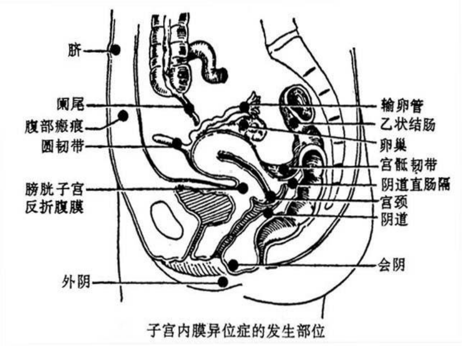 十七章子宫内膜异位症课件.pptx_第3页